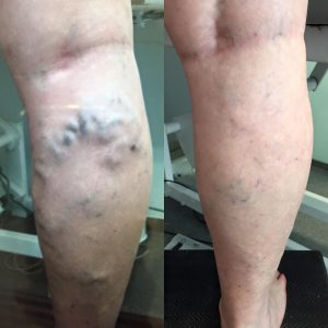 resultado escleroterapia con espuma